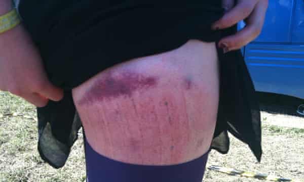 Laura’s Glastonbury leg, with purple bruise