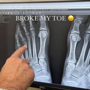 Travis Barker suffers broken toe - Music News