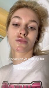 Veronika Rajek has opened up on her e-scooter accident