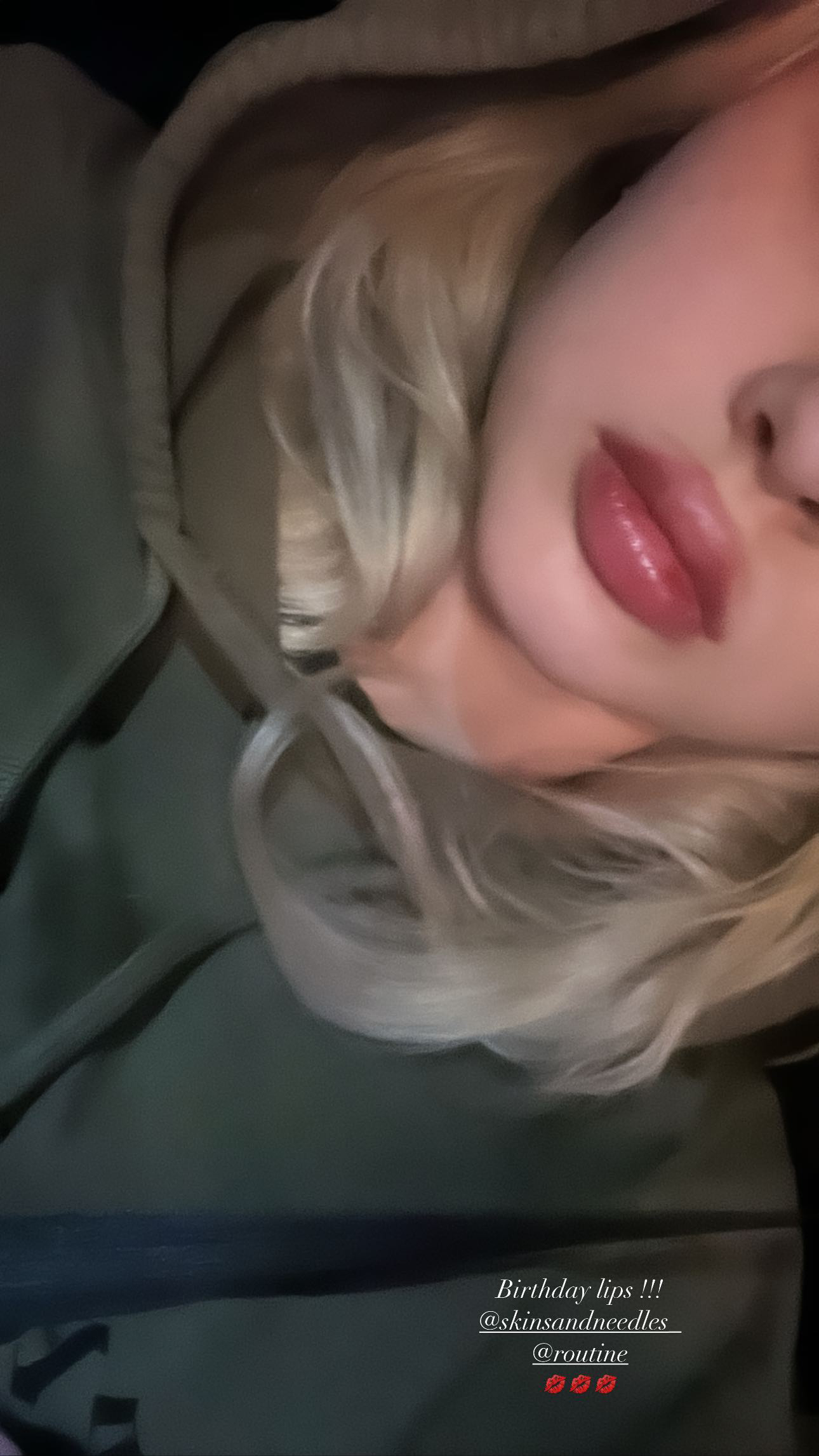She revealed her new swollen lips in a selfie on Tuesday evening