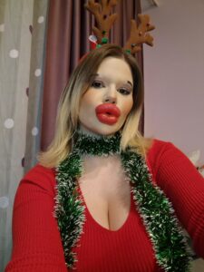 Andrea has the 'world's biggest lips' and she wants them even bigger