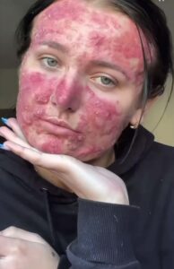 Courtney has suffered with cystic acne since she was 15-years-old