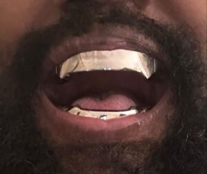 Kanye West showed off his new titanium smile on Instagram