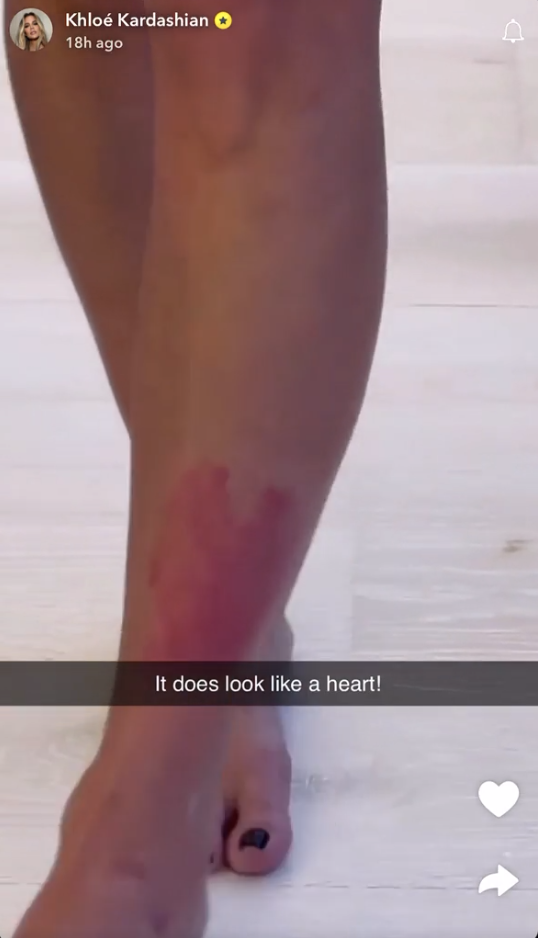 The reality star posted clips of the huge red mark taking over her sibling's leg
