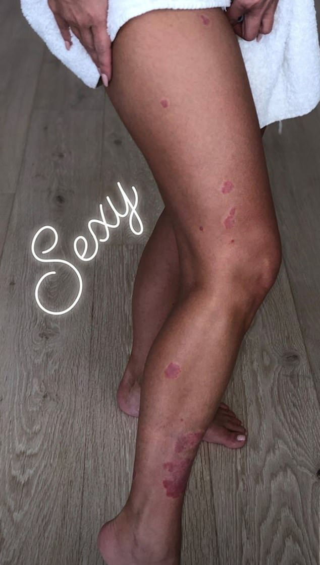 Kim has been honest about her struggles with psoriasis