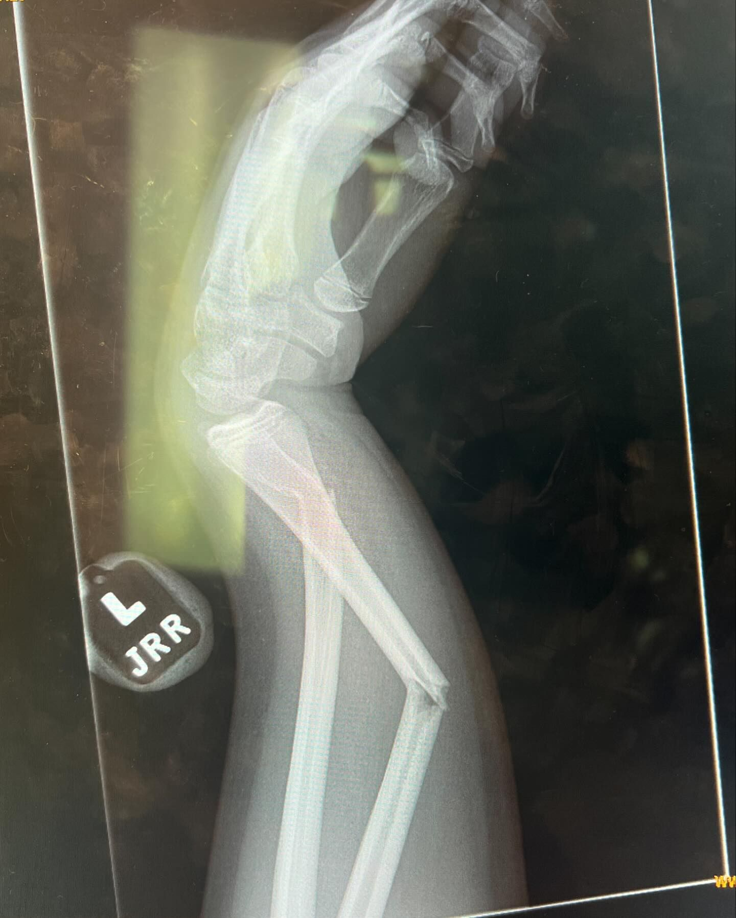 On the sixth slide, the Lemme founder shared an X-ray of a broken arm