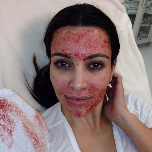 Kim has been known to undergo some wild beauty treatments