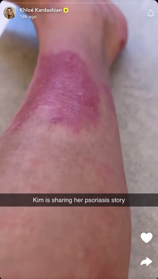 Khloe Kardashian leaked a video of her sister Kim's psoriasis outbreak