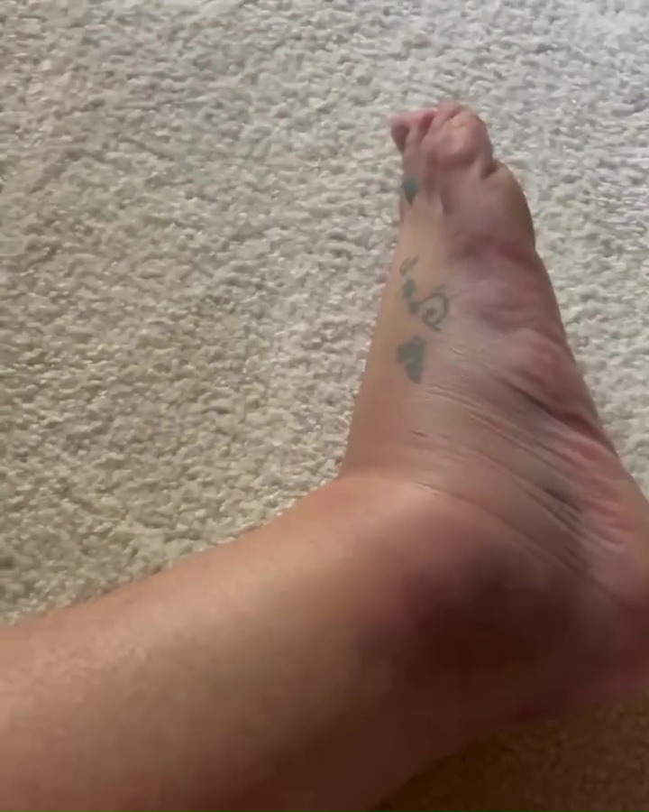 Britney shared videos of her significantly swollen ankle on Instagram following the incident