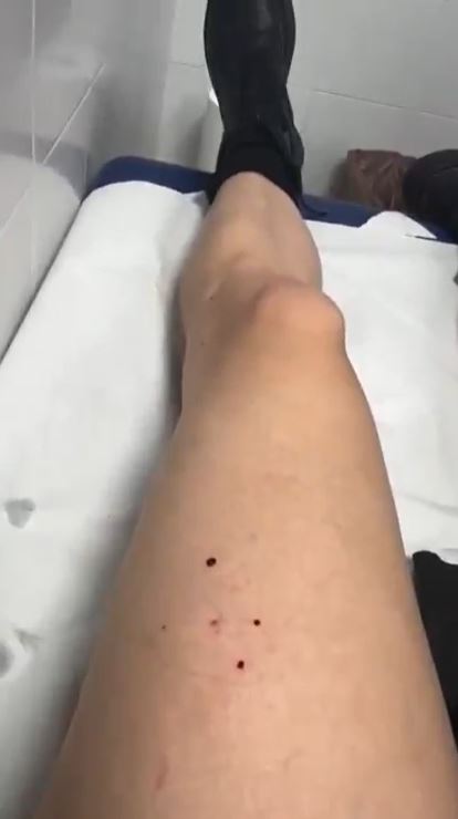 Momsen shared a picture of the four red puncture wounds in her leg later that day