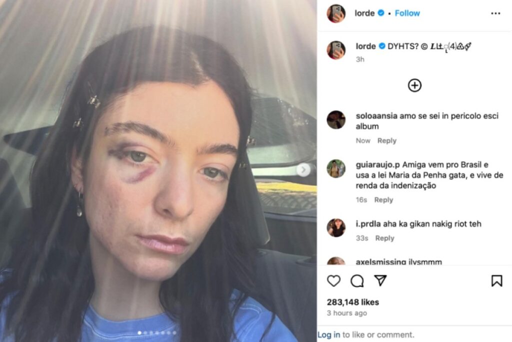 Singer-Lorde-horrifies-fans-with-nasty-black-eye-in-new-photos