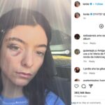 Singer-Lorde-horrifies-fans-with-nasty-black-eye-in-new-photos