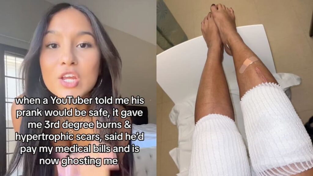 YouTuber Topper Guild accused of “ghosting” TikToker as prank leaves third-degree burns