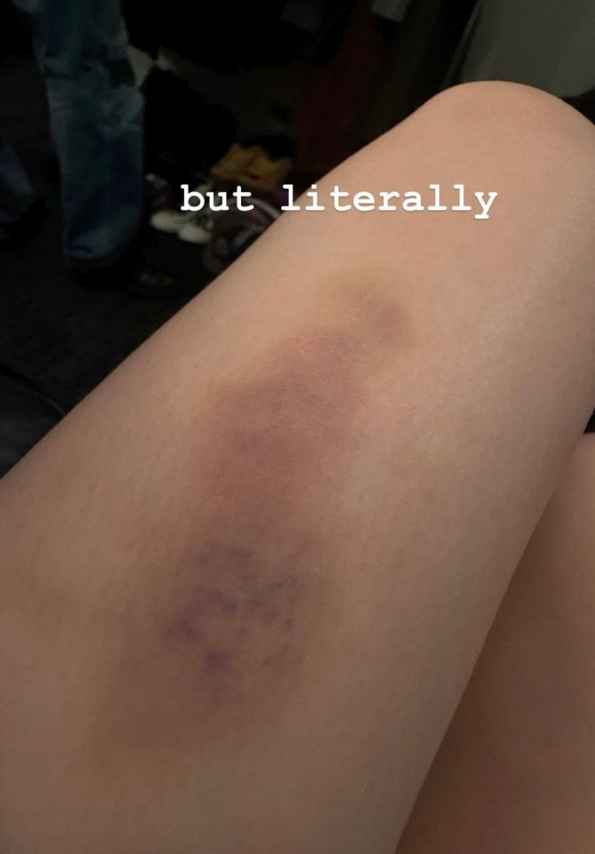 Billie showed off her bruise after the gig