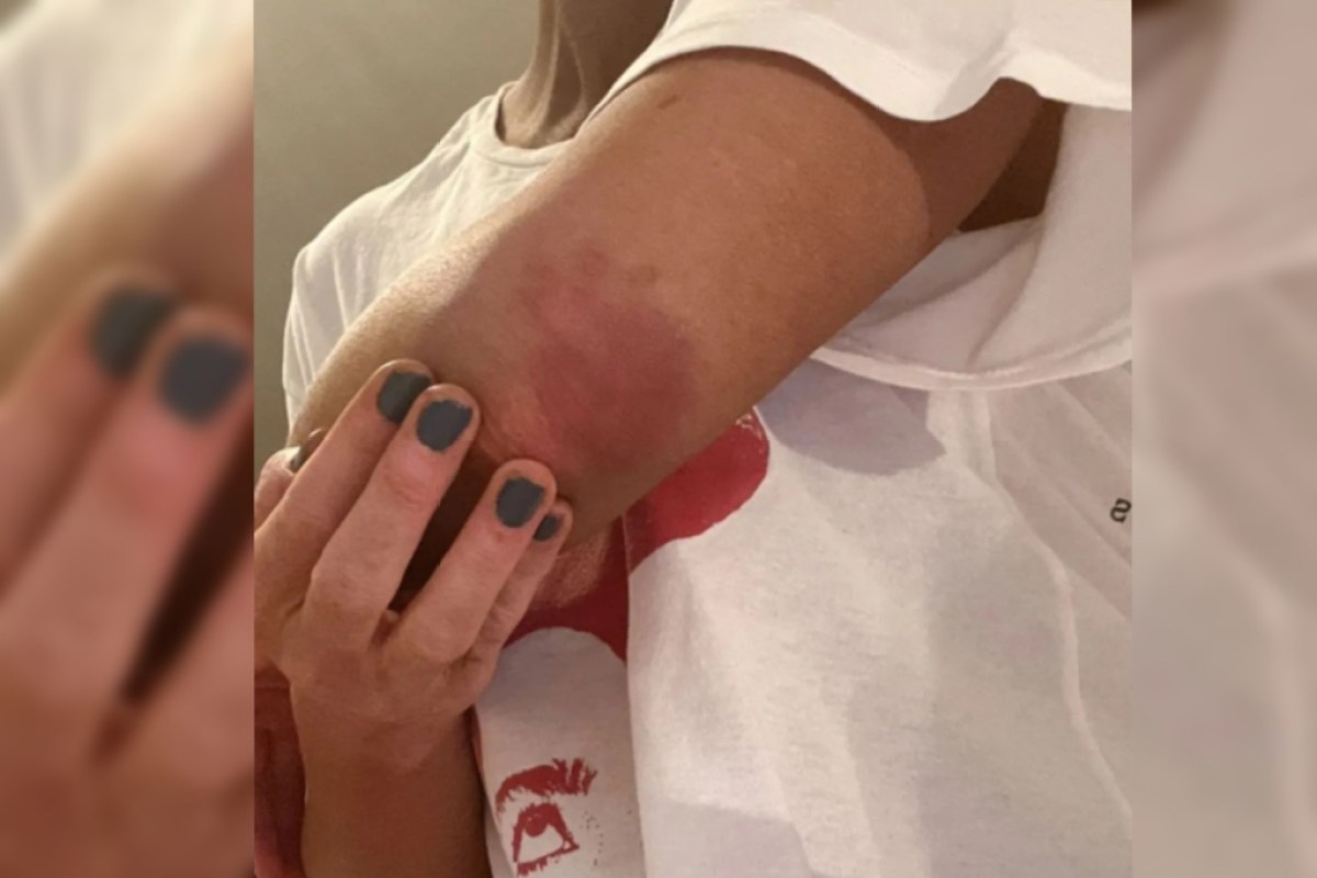 kate-beckinsale-shows-off-horrific-on-set-injuries-in-graphic-photos