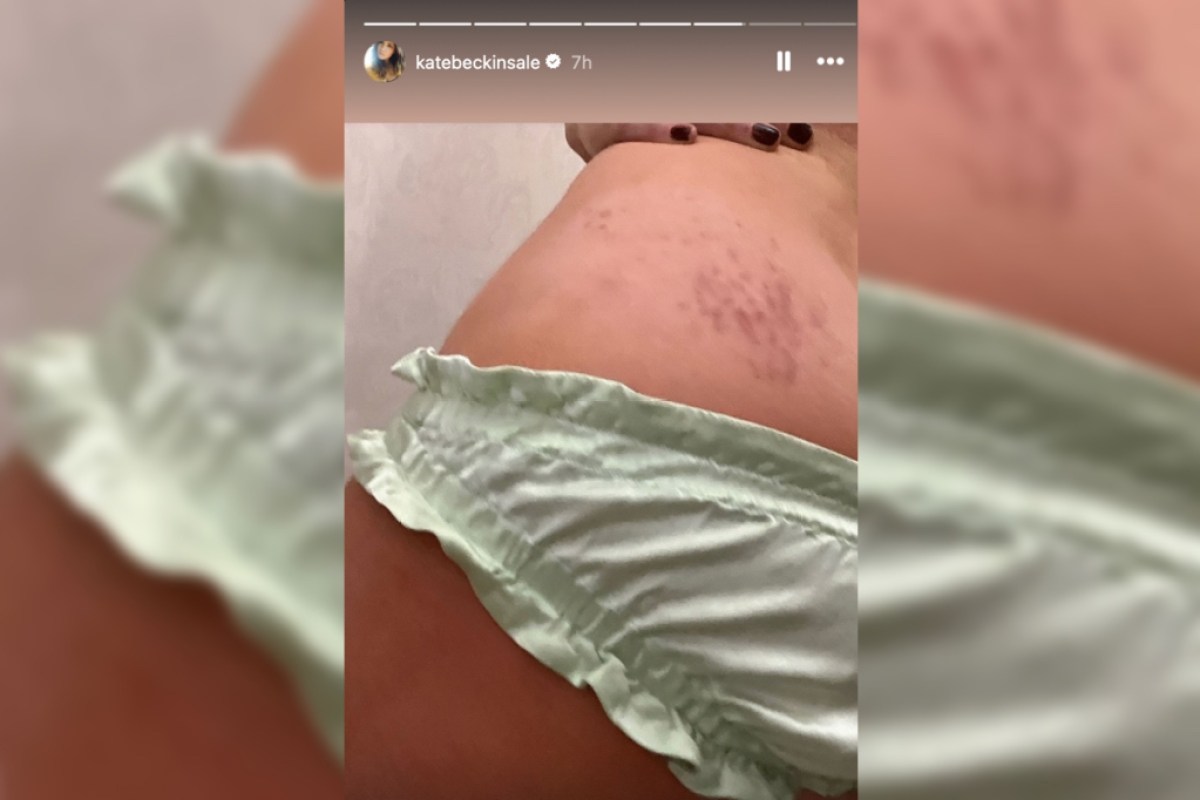 kate-beckinsale-shows-off-horrific-on-set-injuries-in-graphic-photos