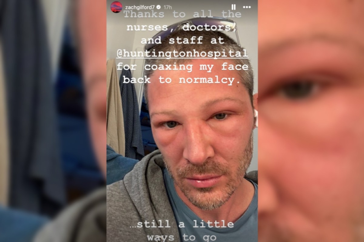 friday-night-lights-star-zach-gilford-shares-shocking-photos-of-swollen-face