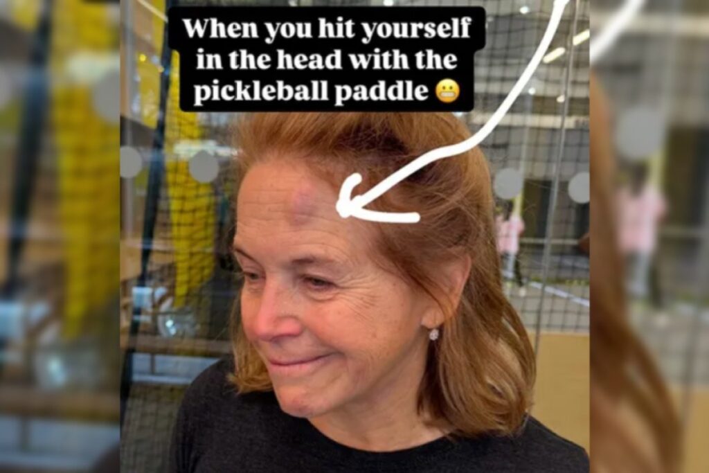 katie-couric-reveals-nasty-forehead-bruise-following-accident-in-new-photos