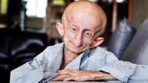 TikTok star Beandri Booysen dies aged 19 from rare disease of rapid aging