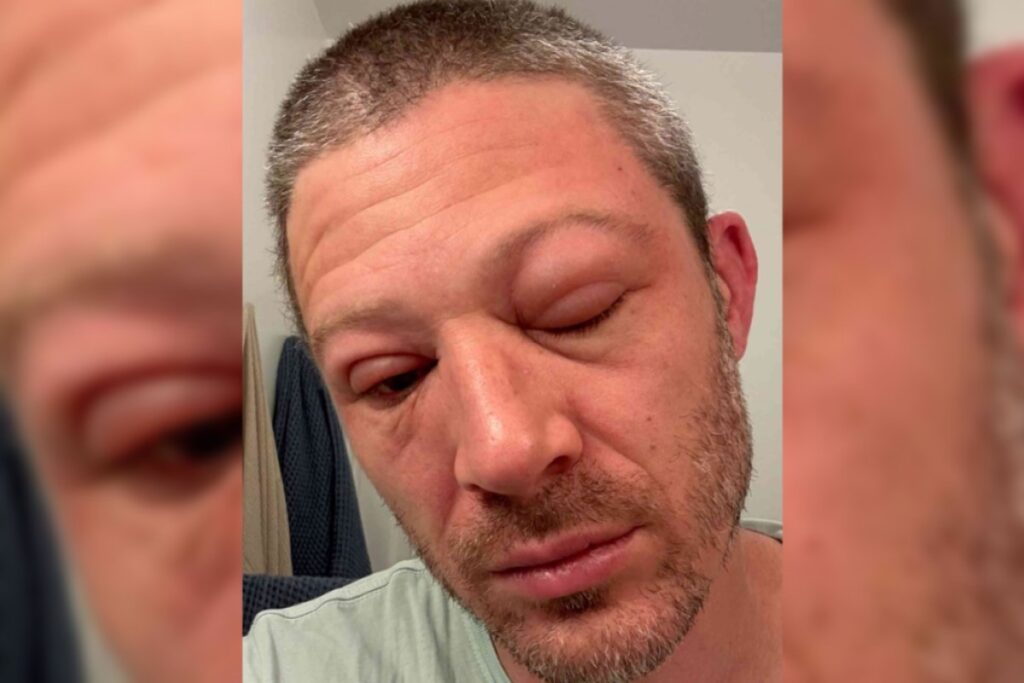 friday-night-lights-star-zach-gilford-shares-shocking-photos-of-swollen-face