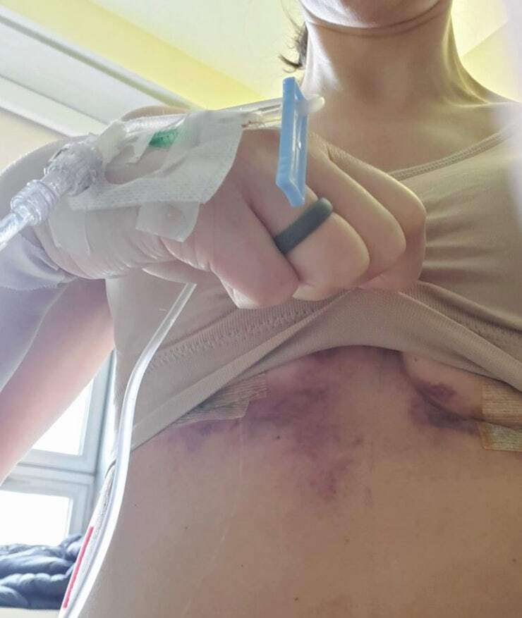 Person with IV line showing bruised chest.