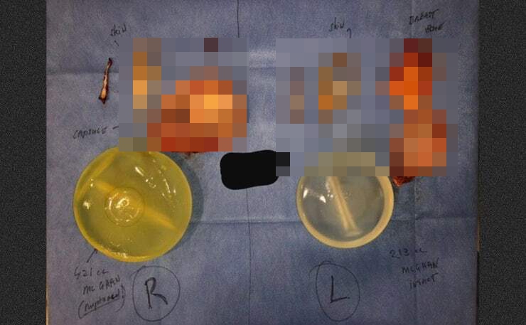 Photo of removed breast implants and tissue samples.