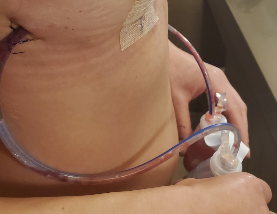 Close-up of a woman's torso with surgical drains attached.