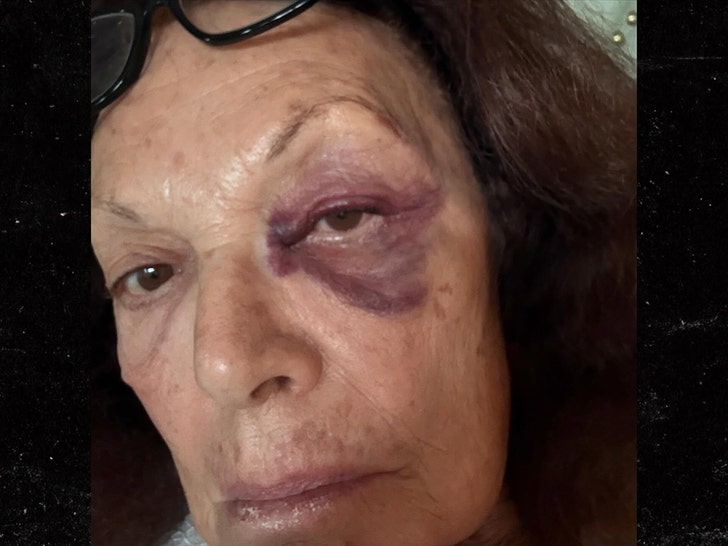 Diane von Furstenberg suffers black eye during fall