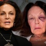 Designer Diane von Furstenberg Suffers Gnarly Black Eye After Fall