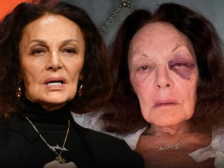 Designer Diane von Furstenberg Suffers Gnarly Black Eye After Fall