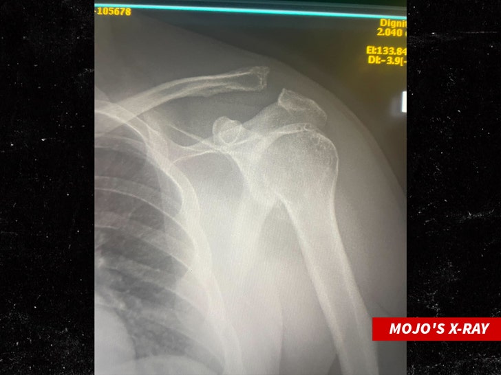 mojo shoulder xray 1