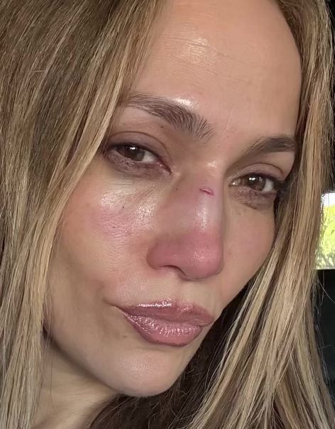 Close-up of Jennifer Lopez's face showing a small injury near her nose.