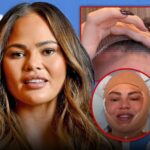 chrissy teigen surgery head stitches main getty instagram composite