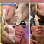 khloe skin cancer
