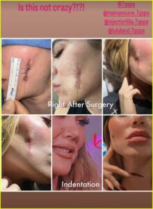 khloe skin cancer