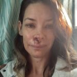 Woman with a bruised face.