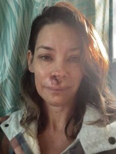 Woman with a bruised face.