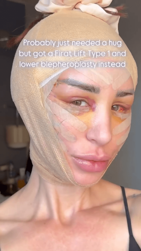 Woman's face after Firat Lift Type 1 and lower blepharoplasty.