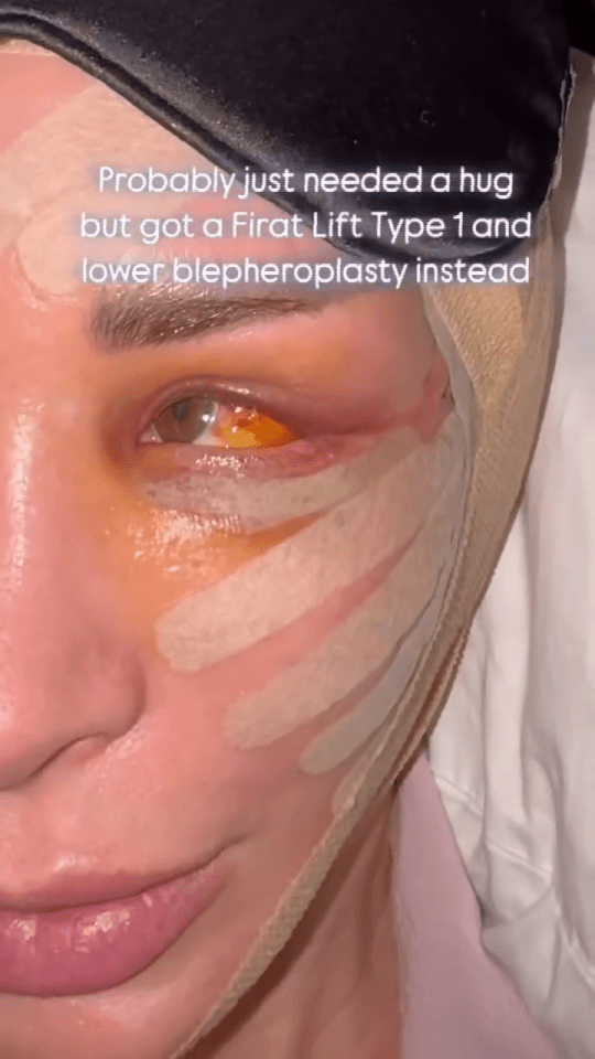 Close-up of a woman's face after a Firat Lift Type 1 and lower blepharoplasty.