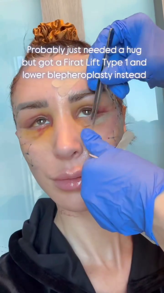 Close-up of a woman undergoing a Firat Lift Type 1 and lower blepharoplasty.