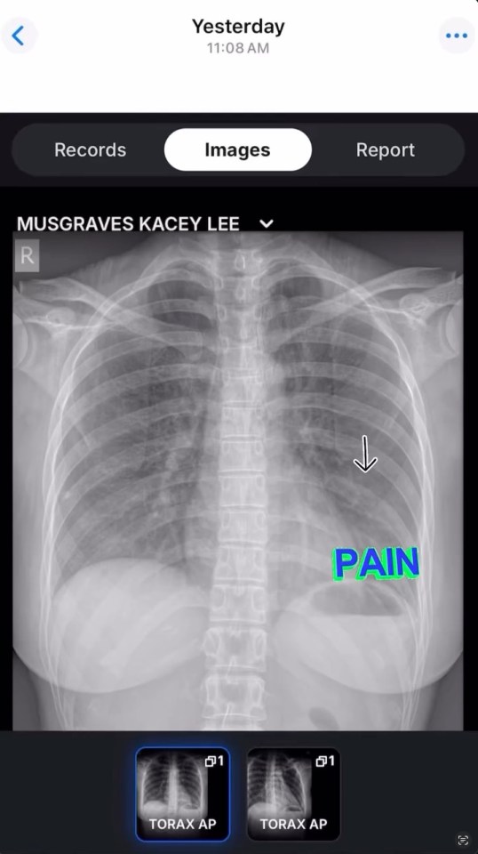Screenshot of chest x-ray with "PAIN" indicated.