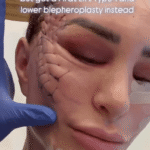 Close-up of a woman's face after a Firat Lift Type 1 and lower blepharoplasty.