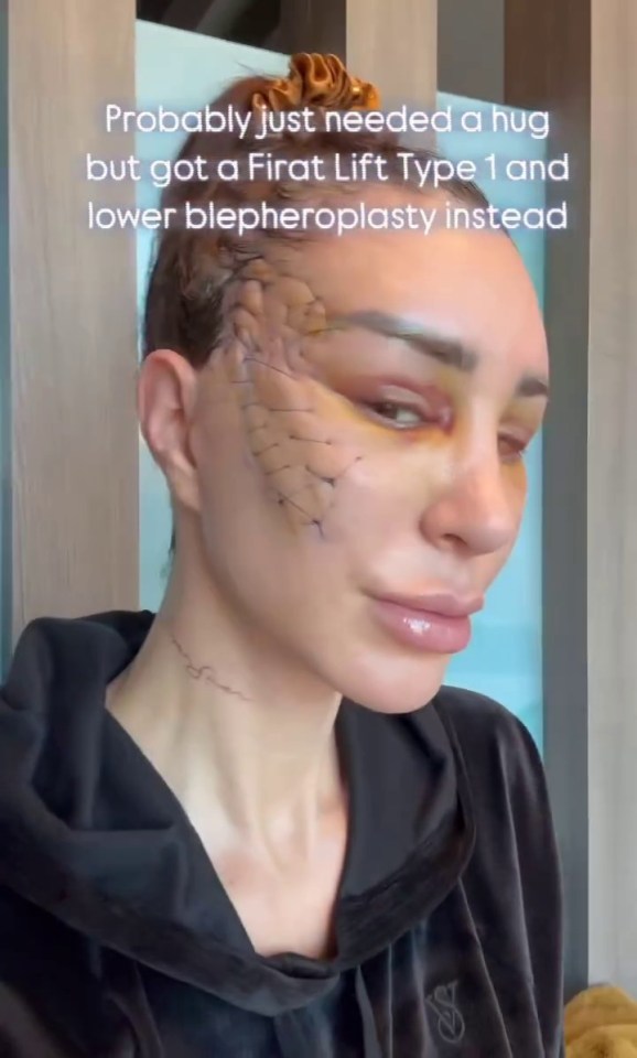 Close-up of a woman's face showing stitches from a Firat Lift Type 1 and lower blepharoplasty.