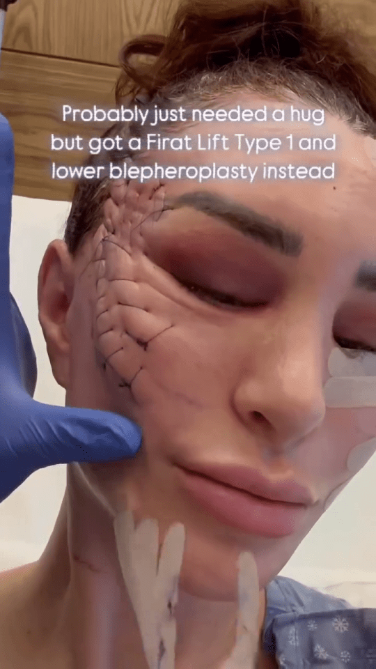 Close-up of a woman's face after a Firat Lift Type 1 and lower blepharoplasty.