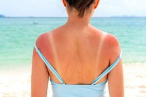 The 1st Thing You Should Do After a Sunburn — Best Life